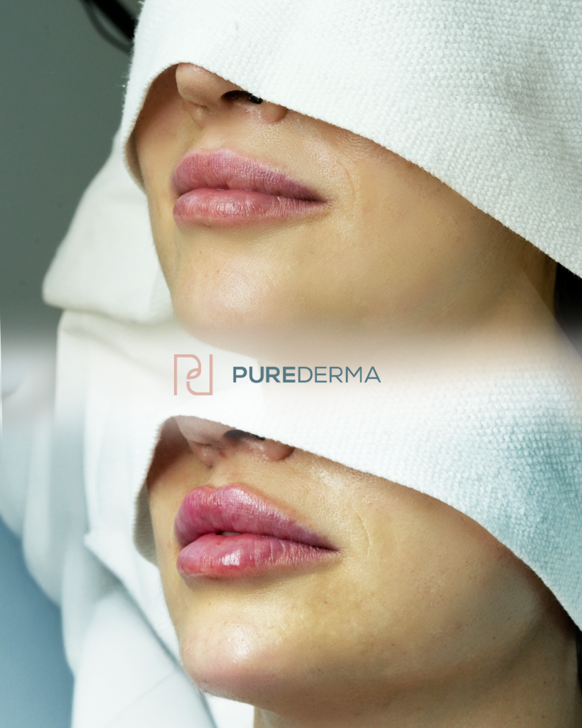 Lip Filler