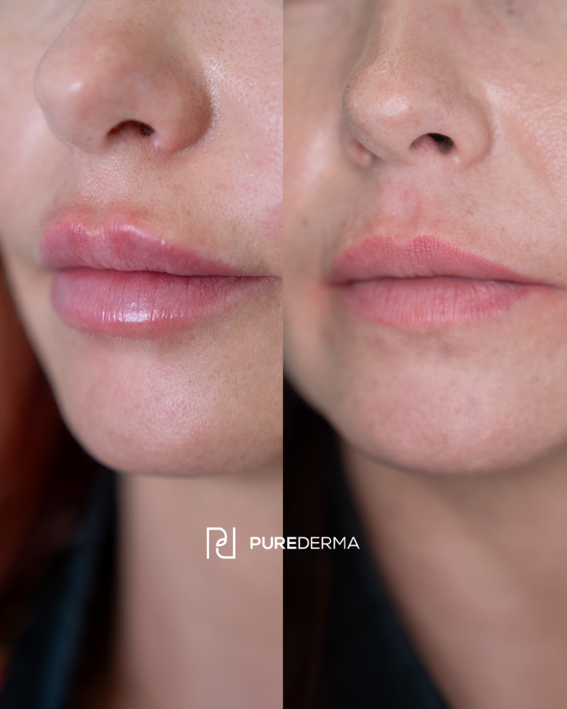 Lip Filler