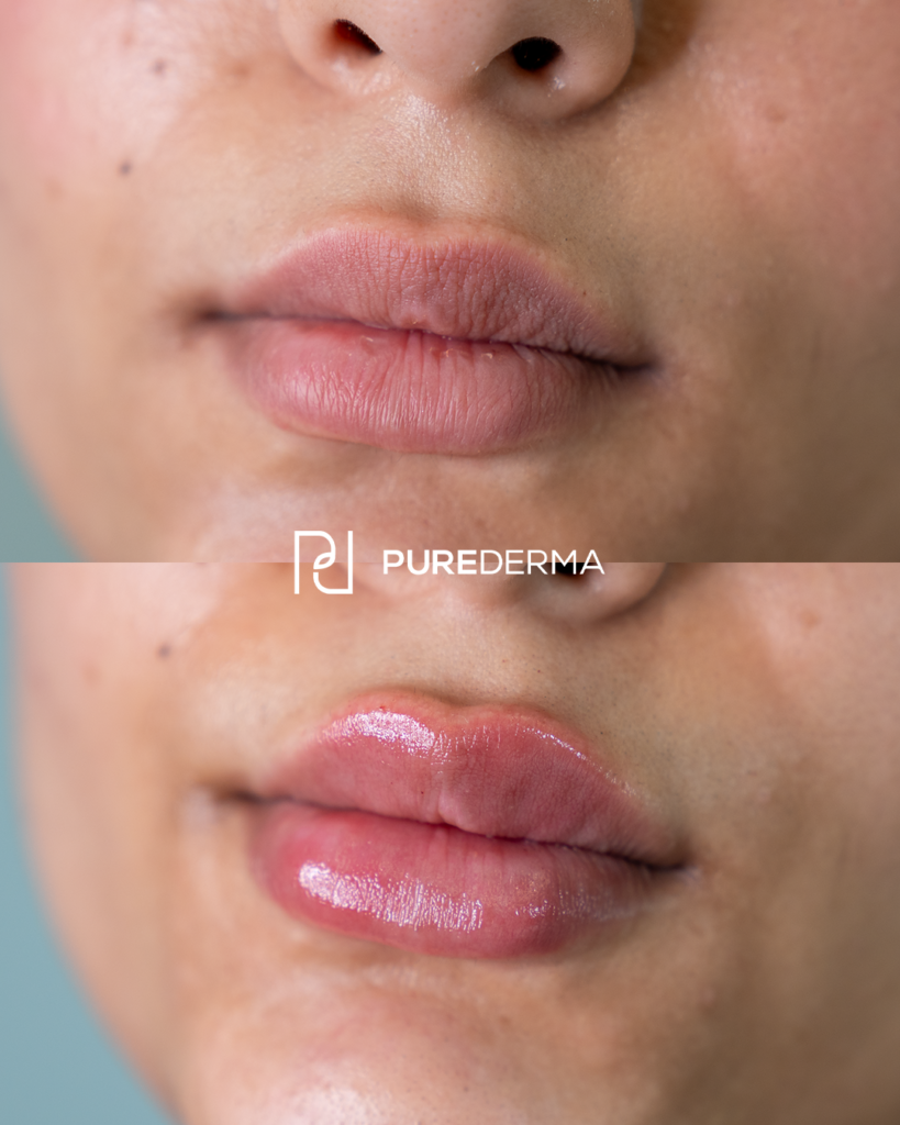 Lip Filler