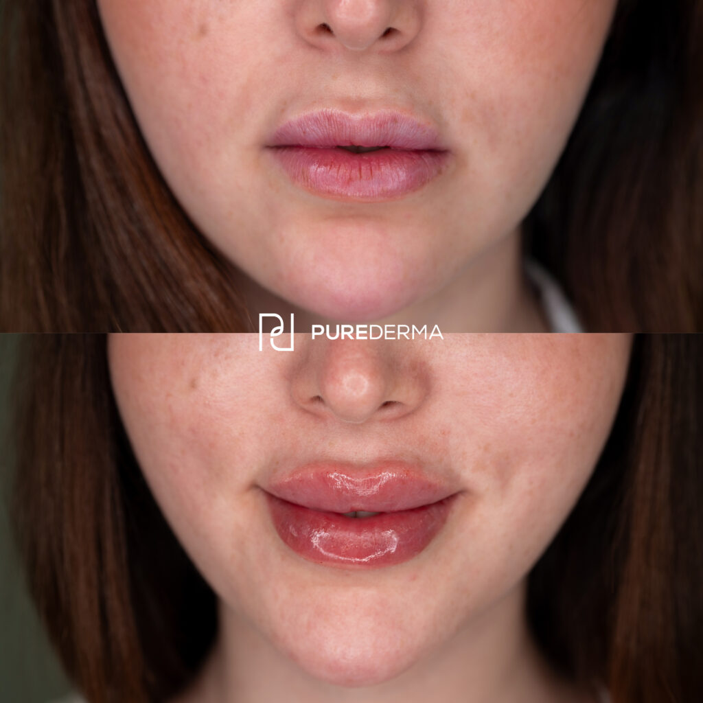 Lip Filler